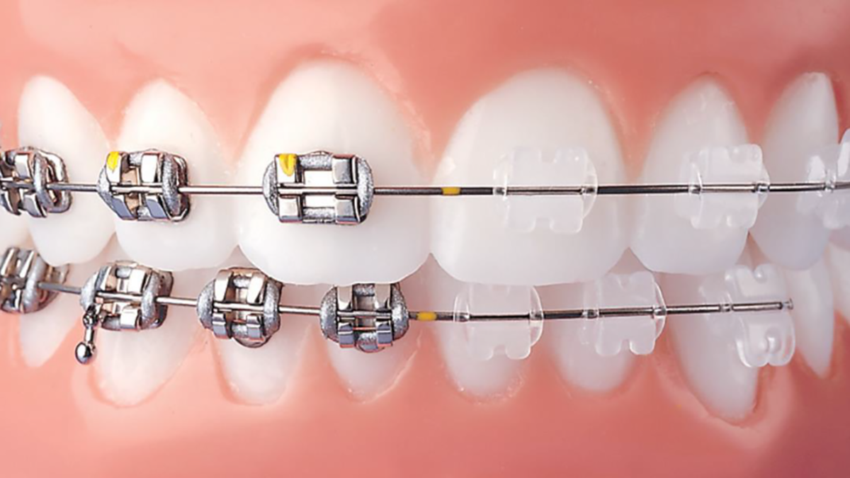 فیلم| مراحل ارتودنسی دندان