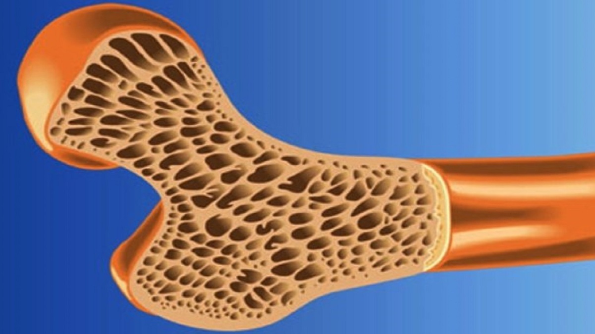 درمان پوکی استخوان با فناوری نانو