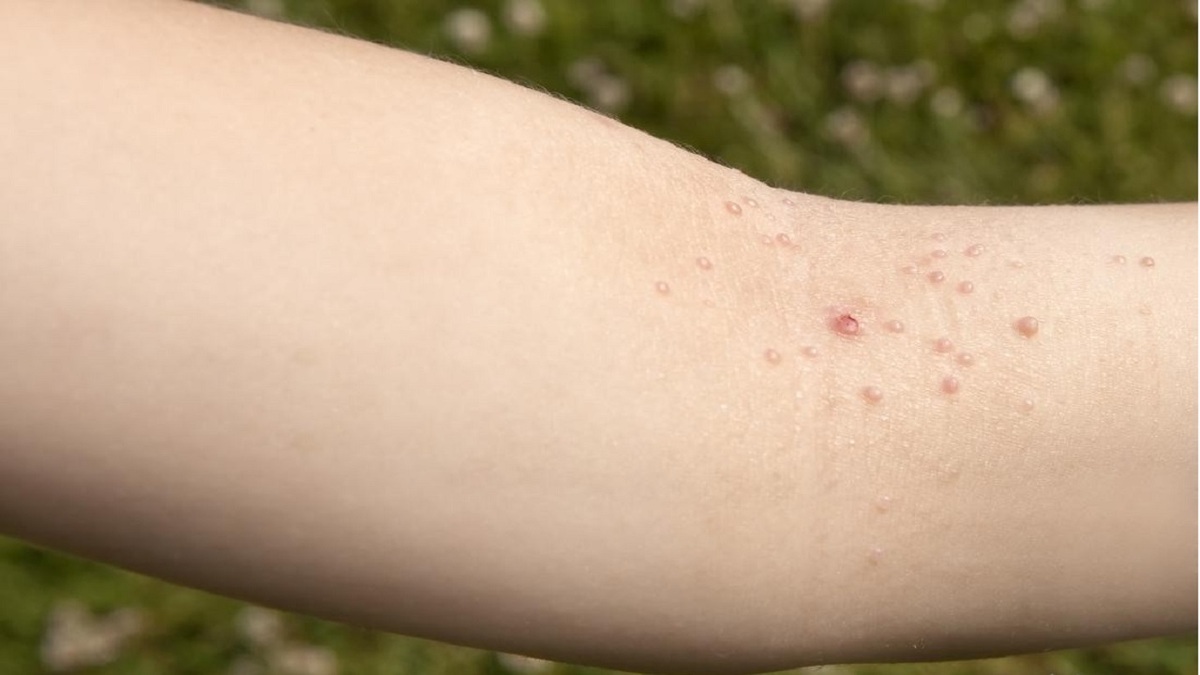 ضعف سیستم ایمنی در کودکان منجر به بروز برخی بیماری‌های پوستی خواهد شد
