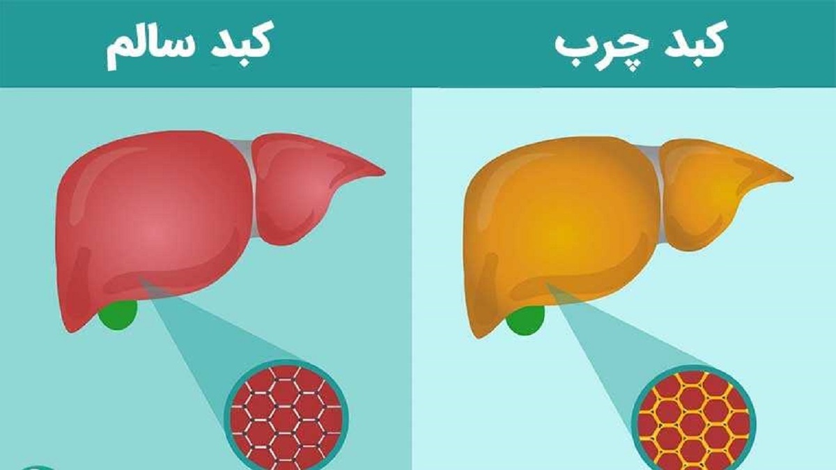 یک ژن مخرب در بیماری کبد چرب شناسایی شد