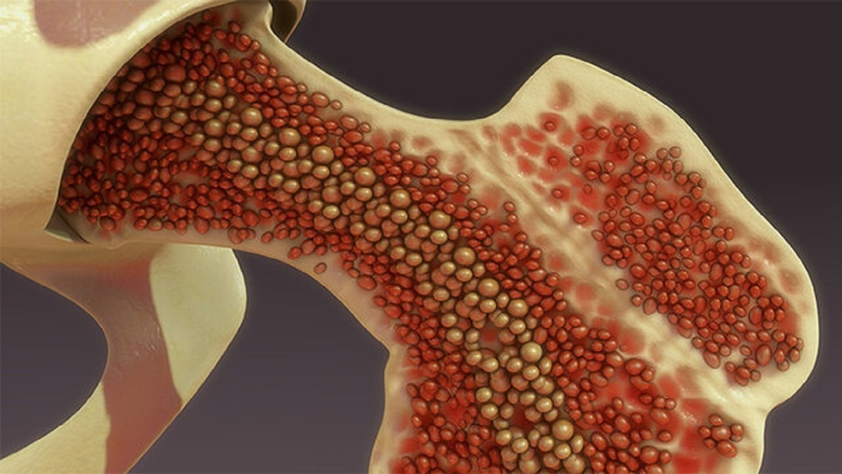 یک روش جدید برای درمان سرطان مغز استخوان!
