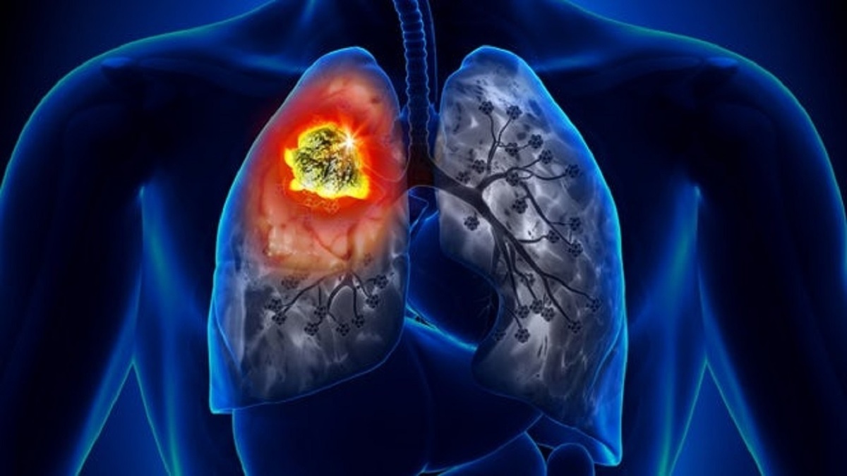 کرونا ویروس سندرم حاد تنفسی ۲ را با این روش سرنگون کنید
