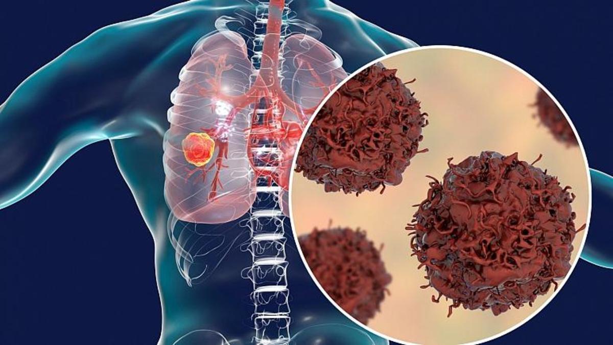 تشخیص سرطان ریه با کرم‌هایی که بو می‌کشند