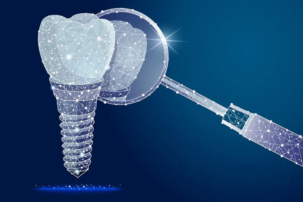 قیمت ایمپلنت دندان در تهران ۱۴۰۱ قیمت ایمپلنت دندان در تهران ۱۴۰۱