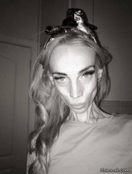 لاغری وحشتناک دختر جوان ۲۵ کیلویی +عکس