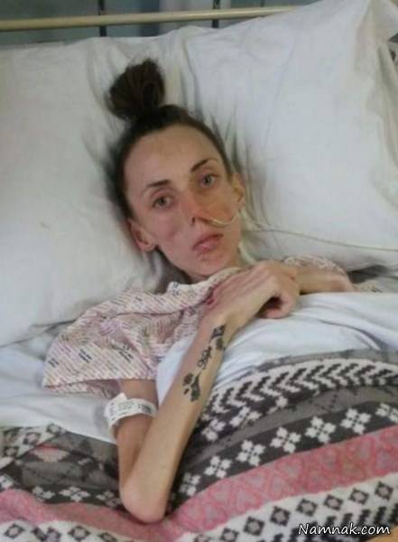 لاغری وحشتناک دختر جوان ۲۵ کیلویی +عکس