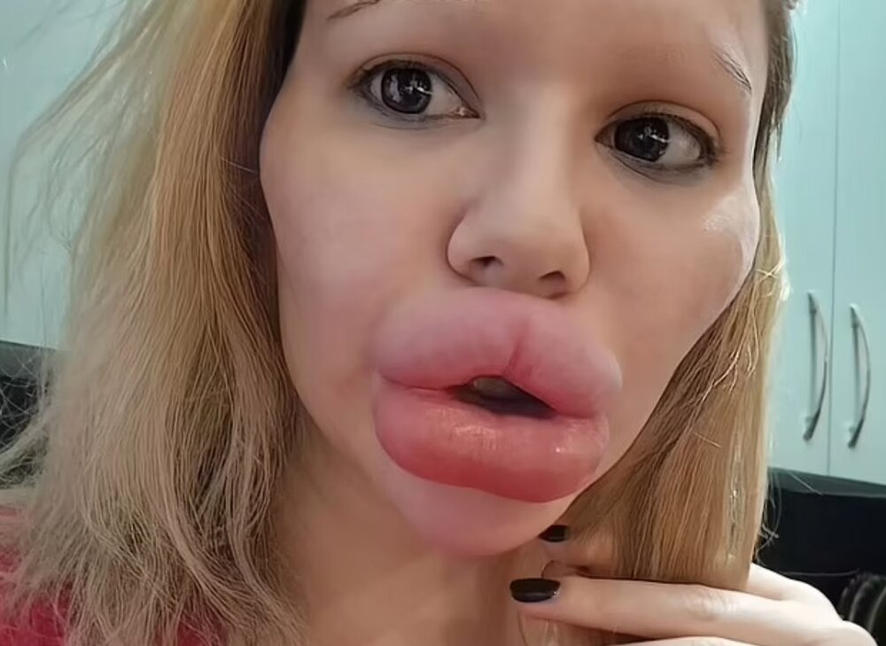 عکس| وحشت نکنید! این زن با تزریق ژل به لب‌هایش می‌خواهد رکورد گینس را بزند