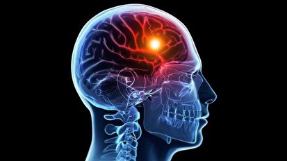 شایع‌ترین عوامل بروز سکته مغزی
