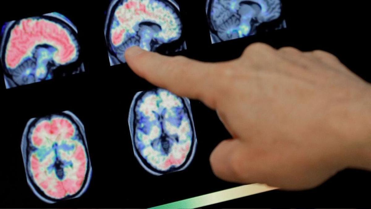 محققان: ابتلای شدید به کرونا مغز را ۲۰ سال پیر می‌کند