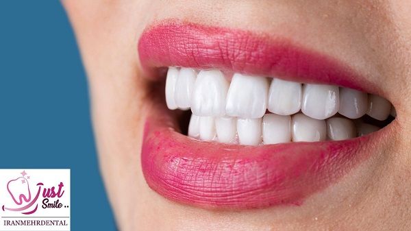 کامپوزیت دندان بهتر است یا روکش؟
