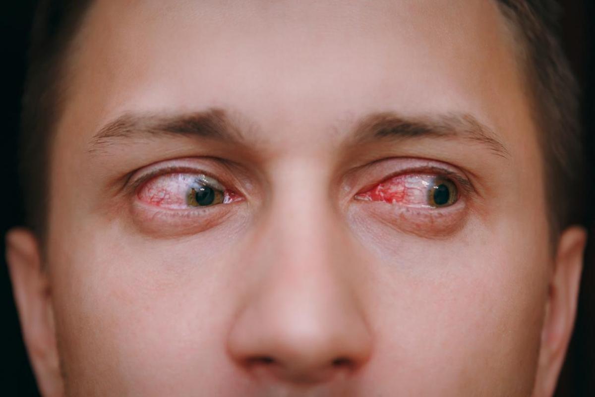 چگونه تورم و قرمزی چشم را با گیاهان دارویی درمان کنیم؟