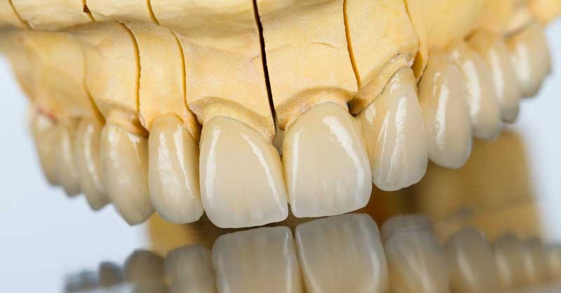 لمینت دندان چند است؟ لمینت دندان چند است؟