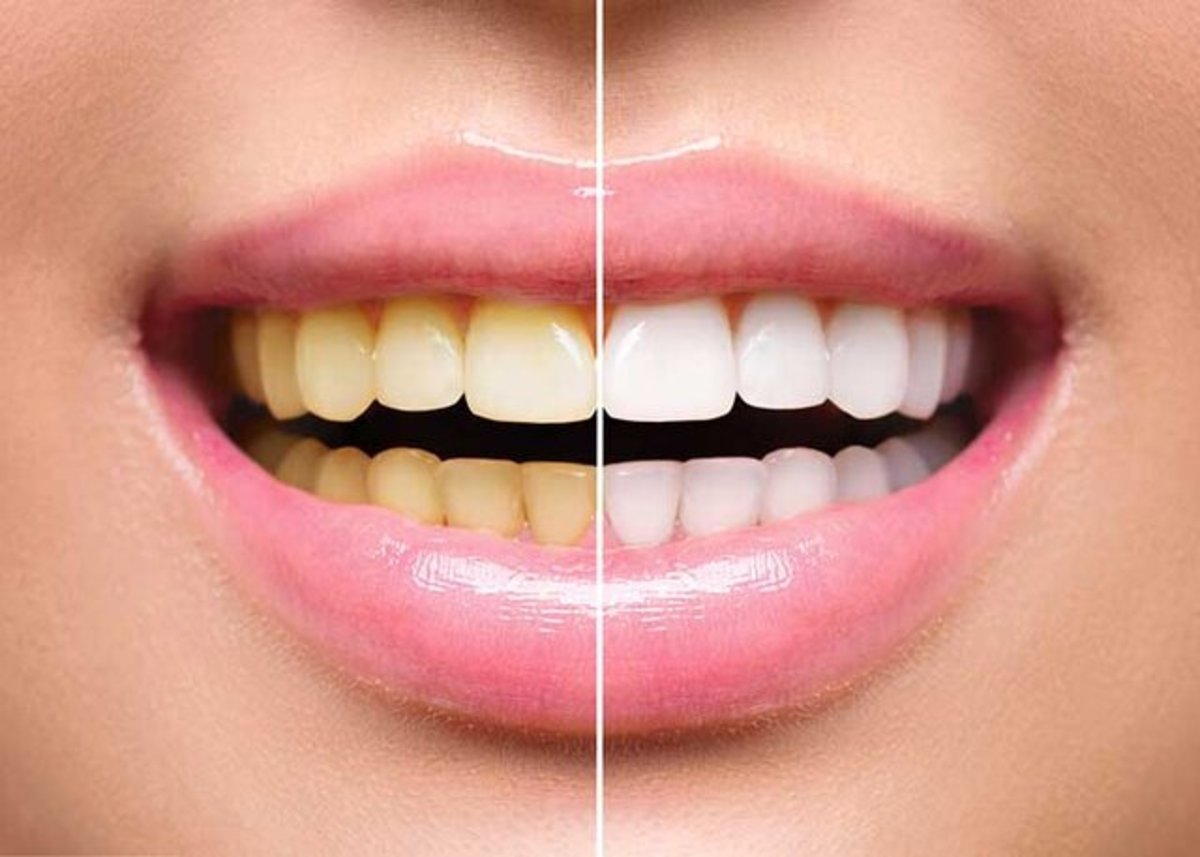سفیدکننده‌های دندان مجاز یا غیر مجاز؟
