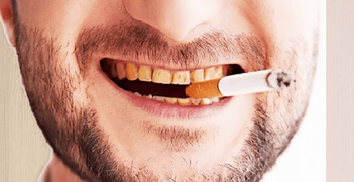 ۷ علت مهم زرد شدن دندان‌ها