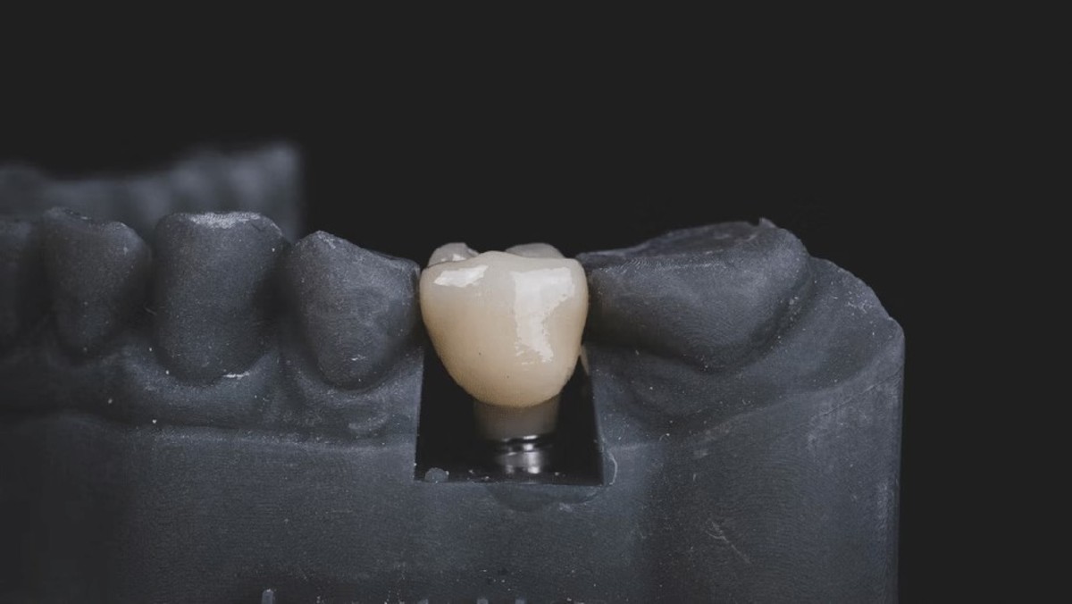 ایمپلنت دندان چیست و برای چه افرادی مناسب است؟