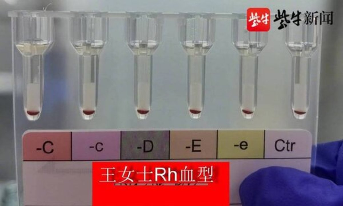 کشف دو بیمار با گروه خون طلایی این بار در چین خبرساز شد!