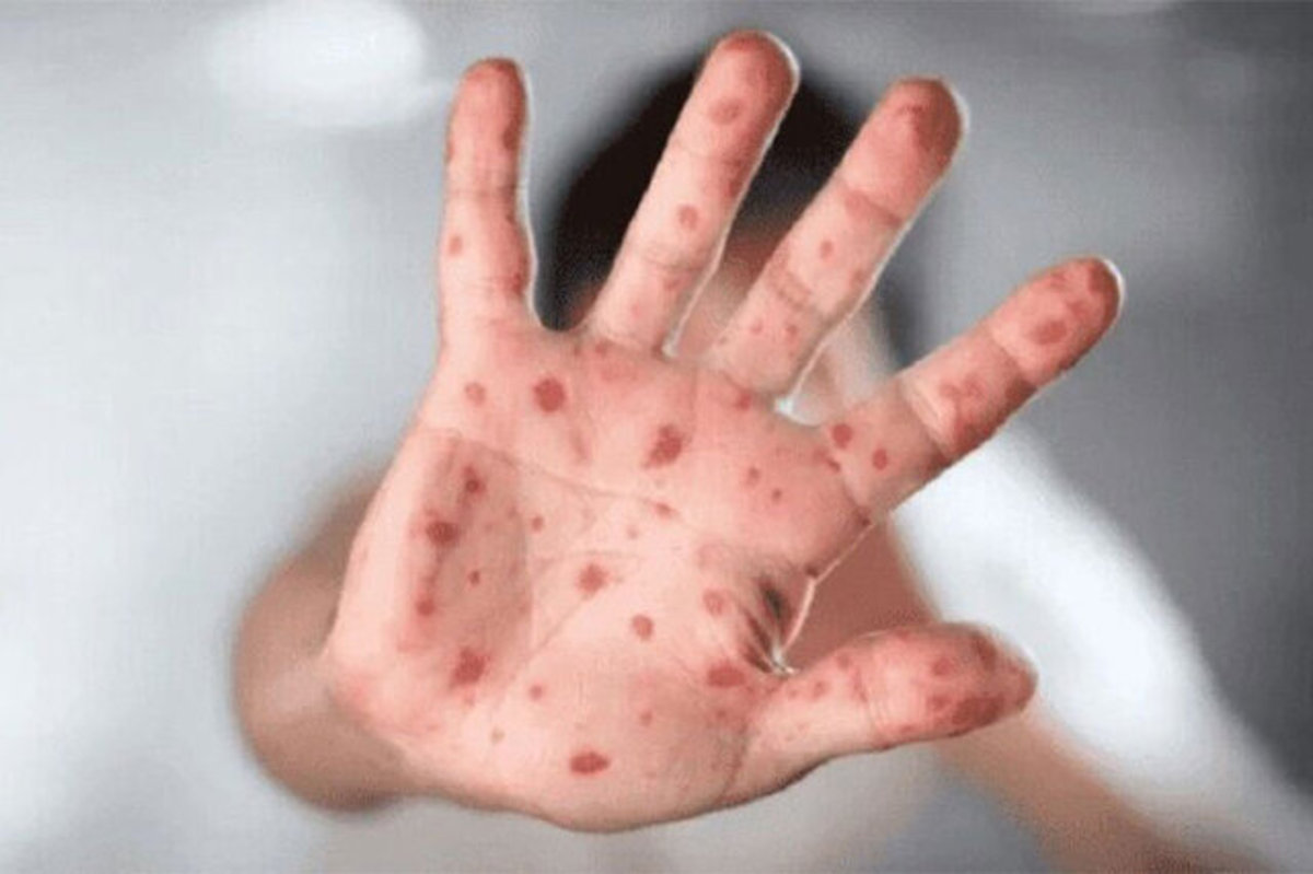 هرآنچه باید راجع به «آبله میمونی» بدانید