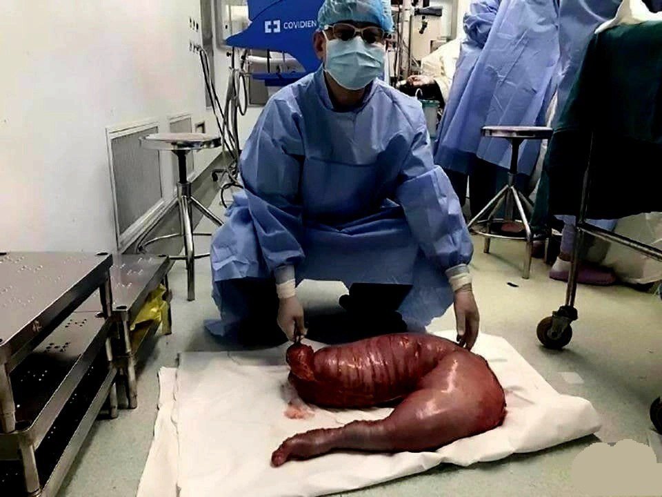 تصویری وحشتناک از روده یک بیمار مبتلا به هیرشپرونگه