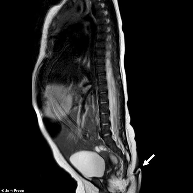 دختری با دم به دنیا آمد؛ پدیدهای بسیار عجیب و نادر / عکس دختری با دم به دنیا آمد؛ پدیدهای بسیار عجیب و نادر / عکس