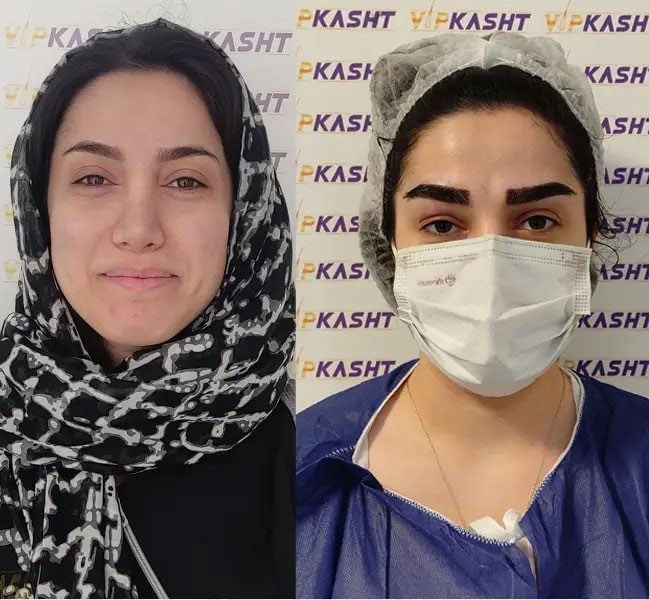 نکاتی درباره کاشت ابرو در تهران