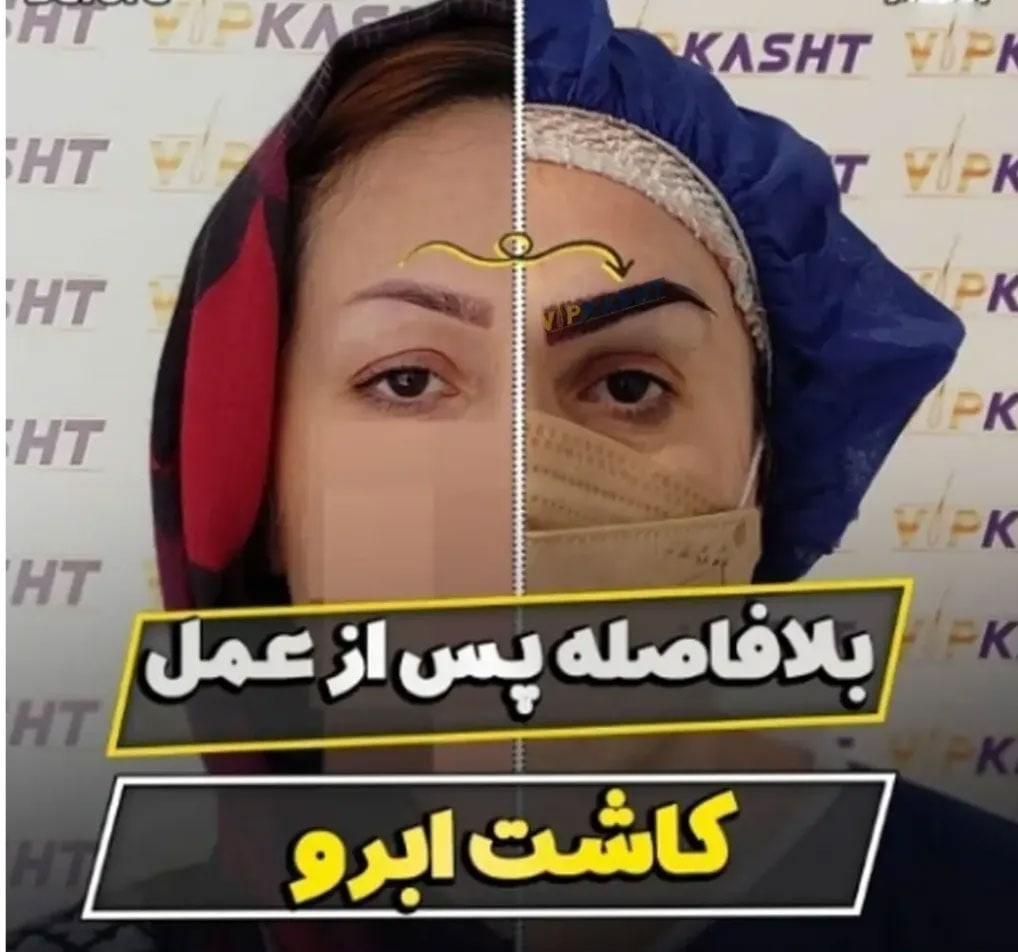 نکاتی درباره کاشت ابرو در تهران