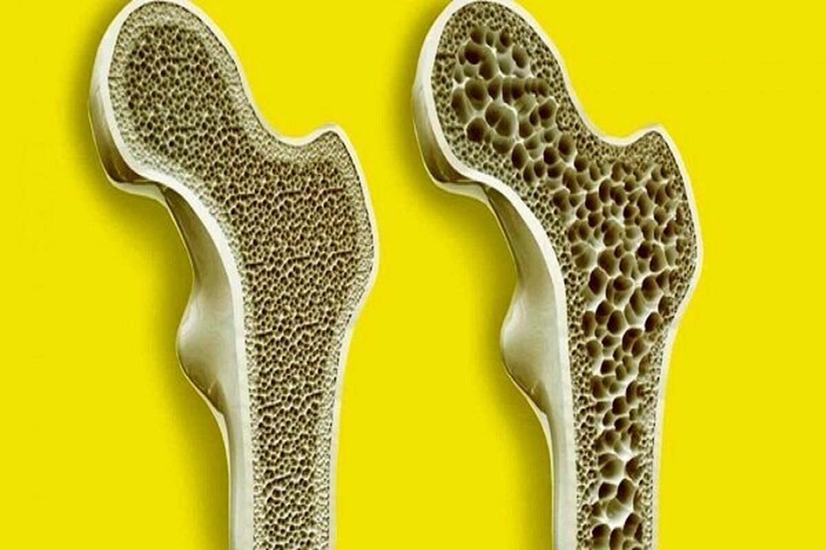 چرا زنان بیشتر از مردان دچار پوکی استخوان می‌شوند؟