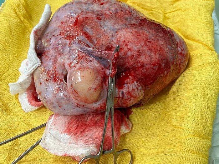 عکس| خارج کردن توده ۲۰ سانتی از شکم زن نیشابوری عکس| خارج کردن توده ۲۰ سانتی از شکم زن نیشابوری