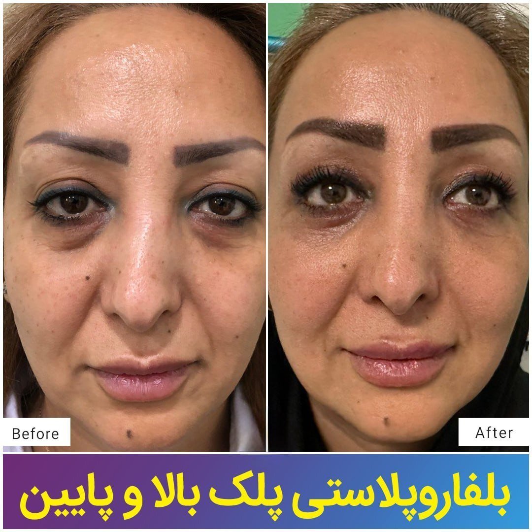 جراحی پلک یا بلفاروپلاستی چیست؟ جراحی پلک یا بلفاروپلاستی چیست؟