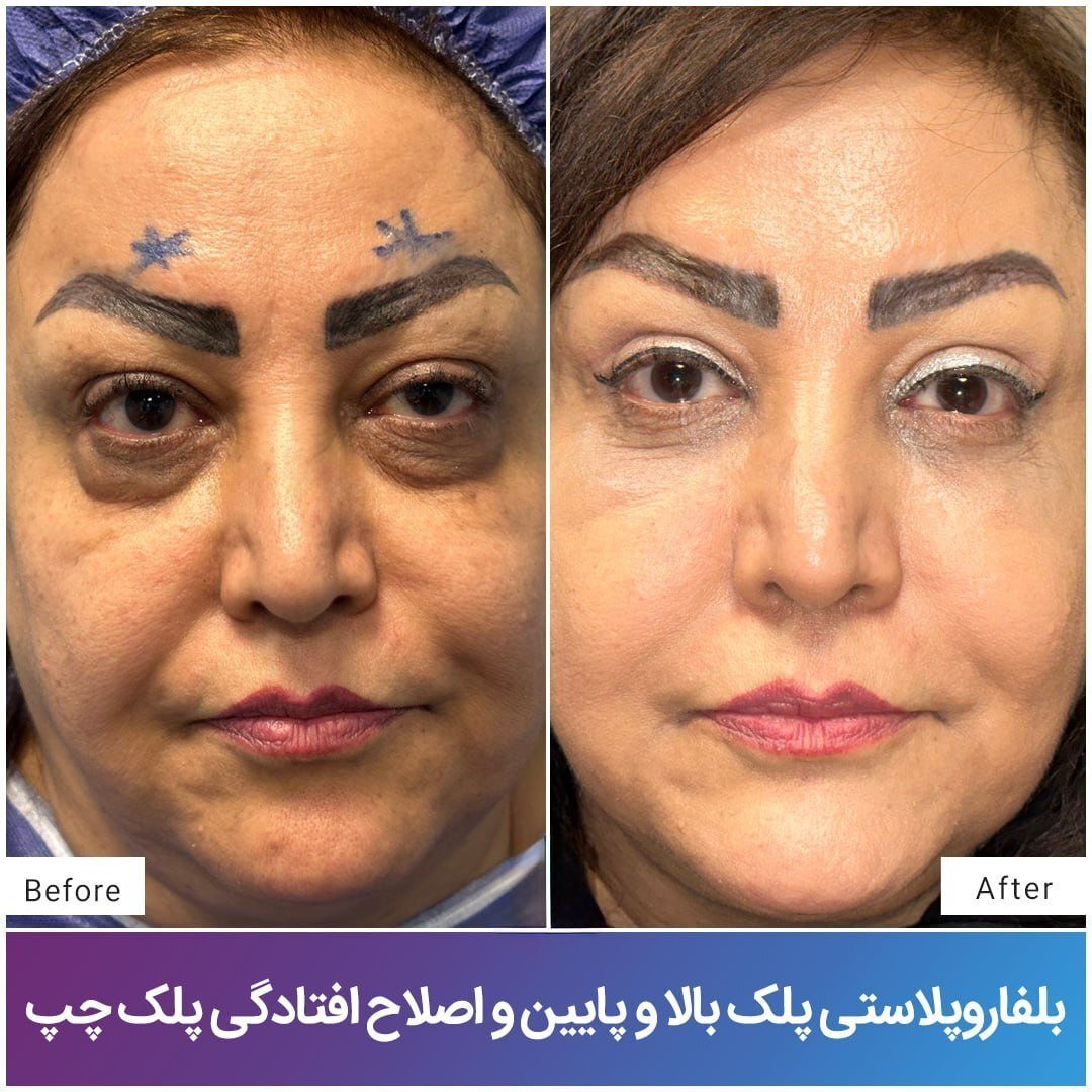 جراحی پلک یا بلفاروپلاستی چیست؟ جراحی پلک یا بلفاروپلاستی چیست؟