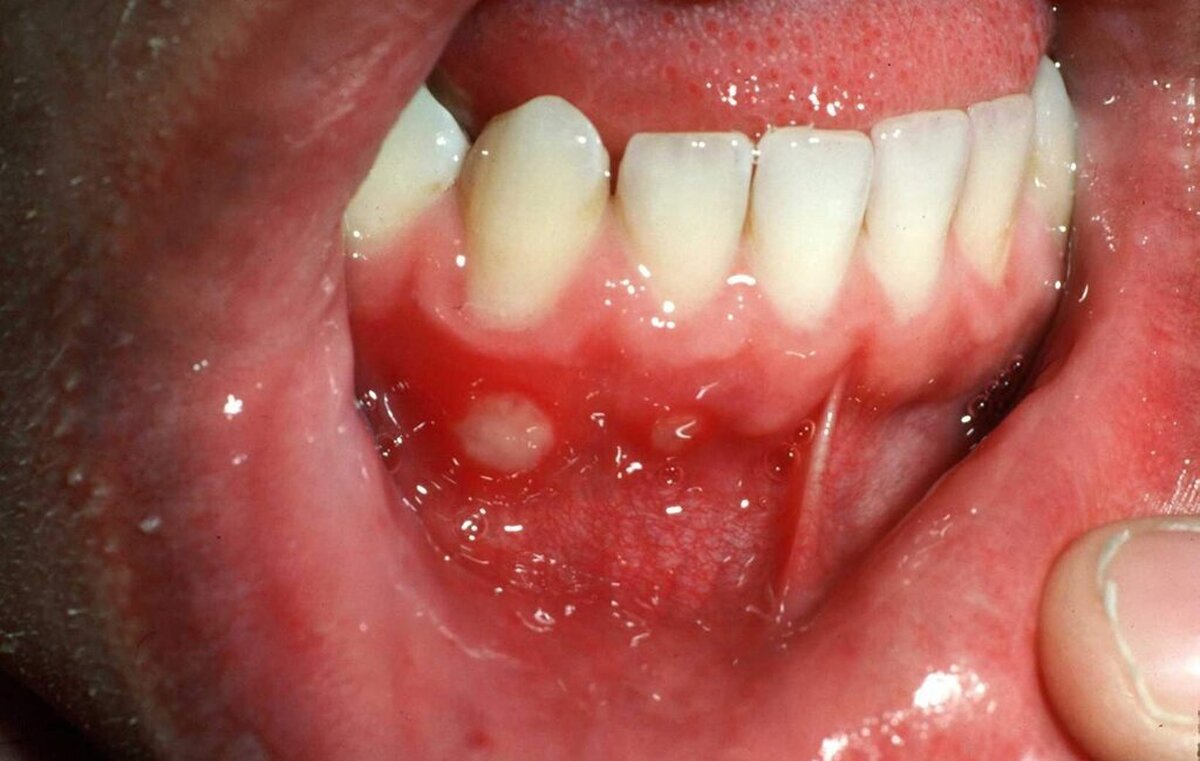 آفت دهانی را چطور درمان کنیم؟