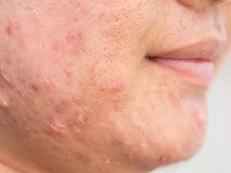 همه چیز درباره دلایل ایجاد جوش و روش‌های جلوگیری از آن