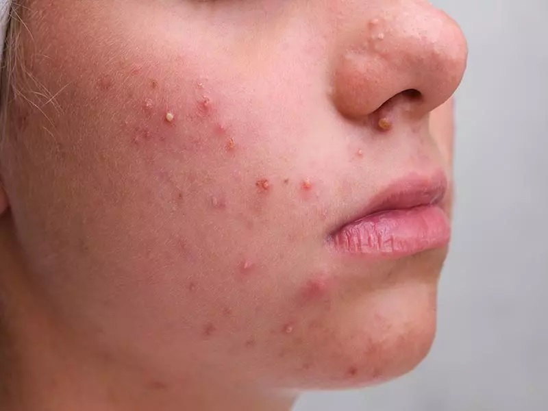 همه چیز درباره دلایل ایجاد جوش و روش‌های جلوگیری از آن