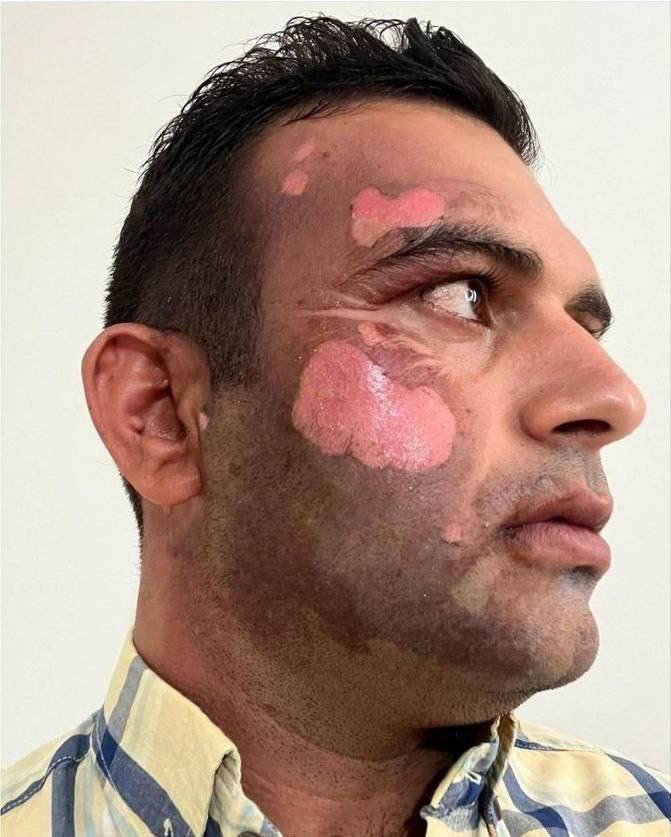 عکس| سوزاندن صورت یک محیط‌بان توسط یک شکارچی