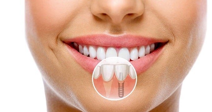 ۶ اصل موفقیت آمیز در ایمپلنت دندان