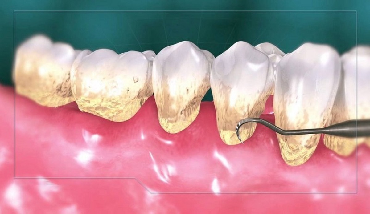 عوارض جرم گیری بر روی دندان‌ها