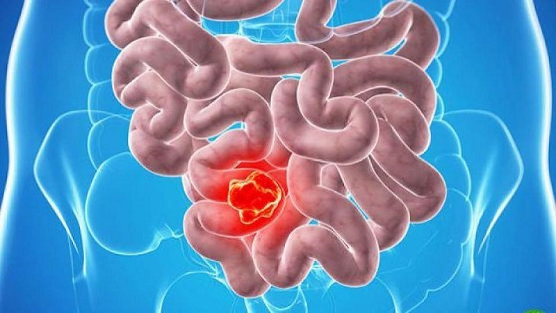 علت و علائم سرطان روده در افراد
