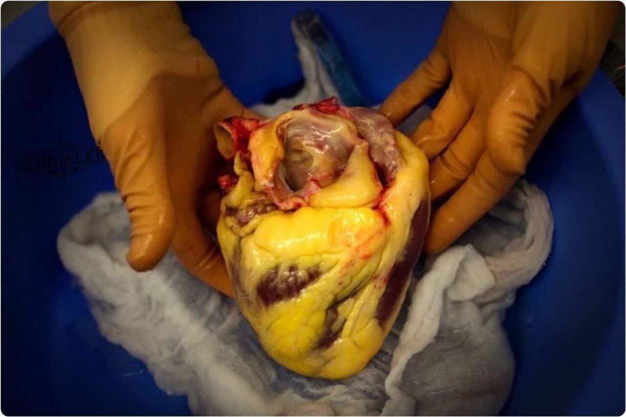 عکس| تصویری باورنکردنی از قلبِ شخصِ چاق فوت شده در اثر سکته قلبی