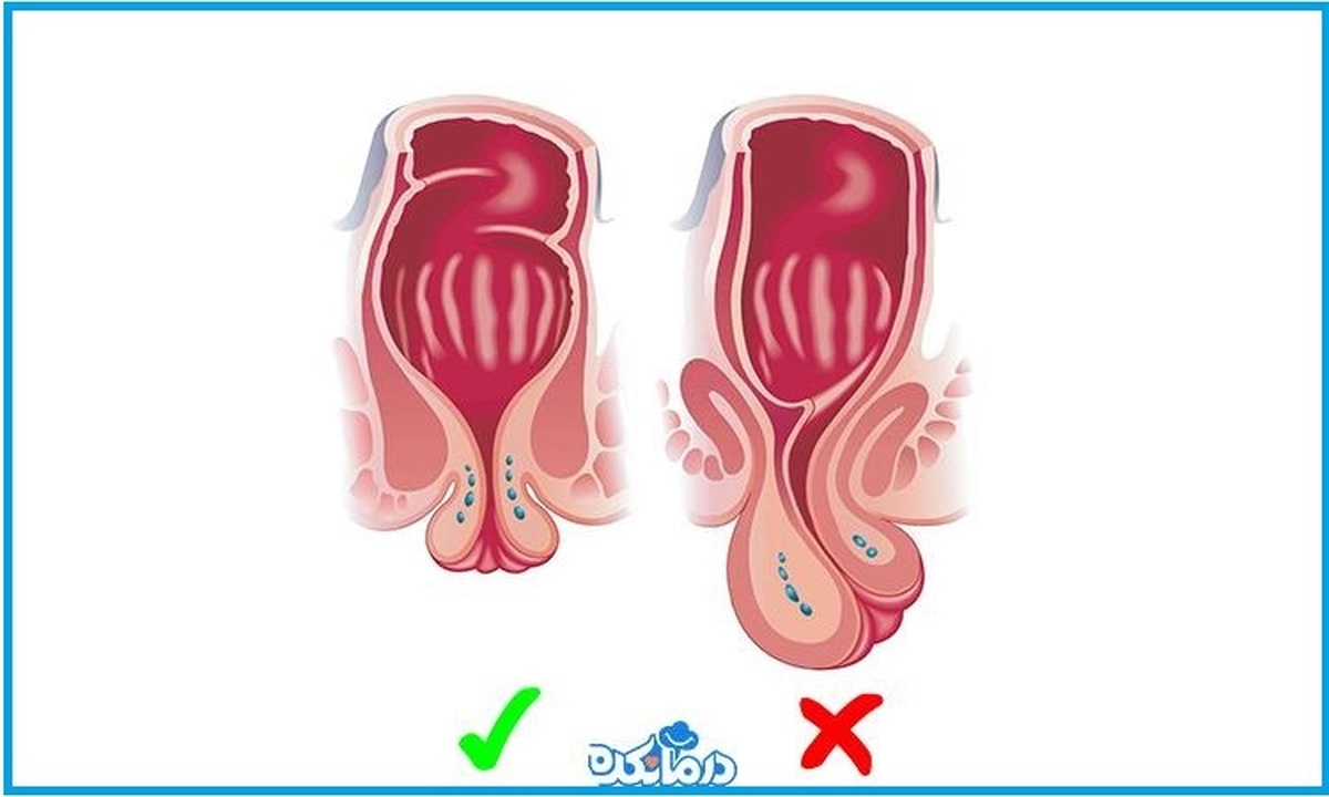 آیا افتادگی رحم خطرناک است؟