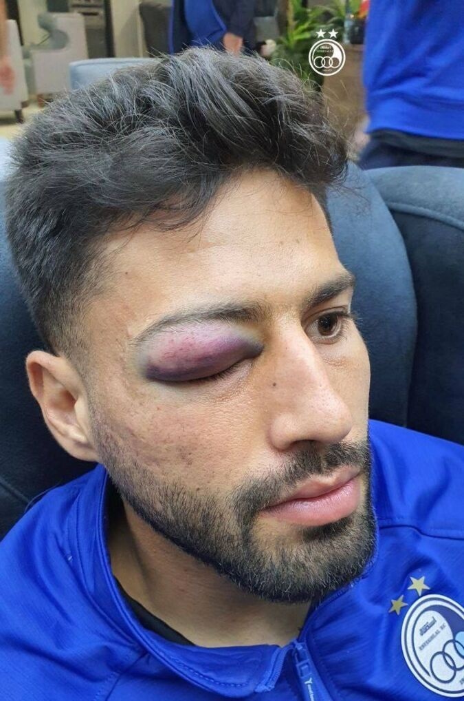 مصدومیت سنگین ایمان سلیمی / نگرانی نکونام برای دربی مصدومیت سنگین ایمان سلیمی / نگرانی نکونام برای دربی