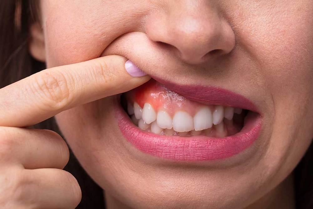 کارسینومای دهان کارسینومای دهان