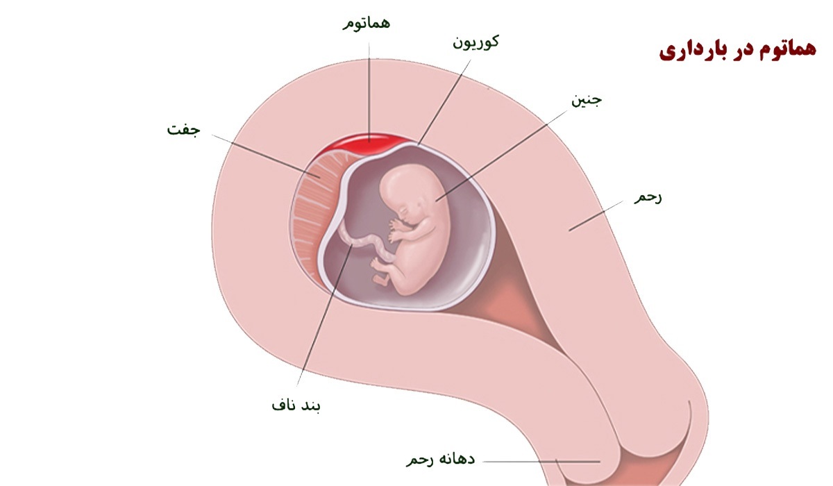 هماتوم بارداری چگونه جذب می شود؟