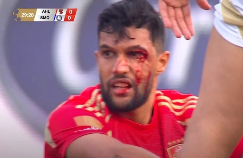 استخوان صورت گزینه سابق پرسپولیس شکست