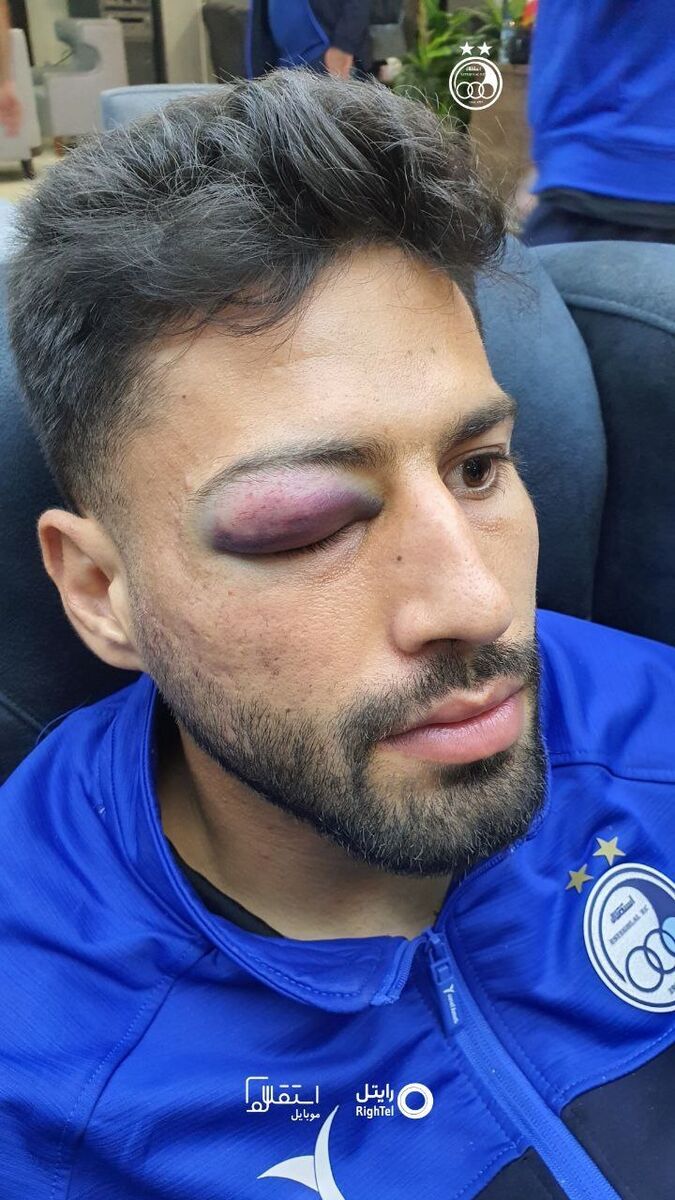 ایمان سلیمی دوباره از ناحیه چشم مصدوم شد