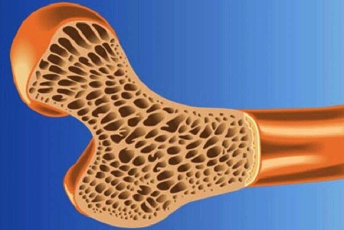 درمان‌های مختلف پوکی استخوان را بهتر بشناسید