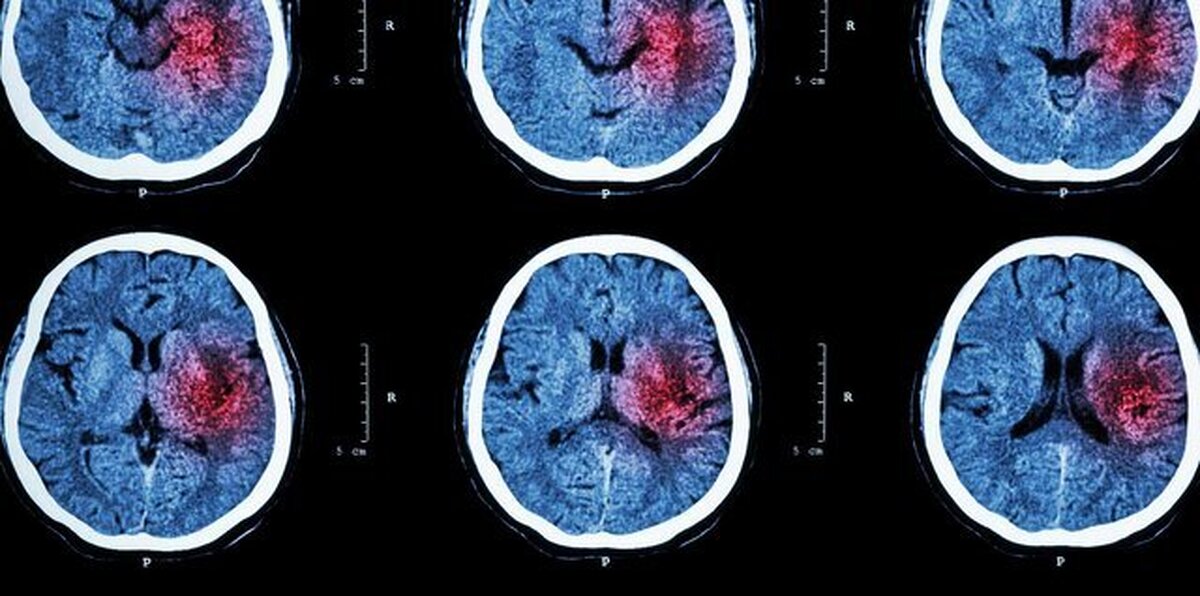 خونریزی مغزی و خطر ۲ برابری ابتلا به زوال عقل