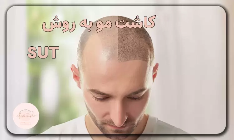 چگونه بهترین روش کاشت مو مناسب با خودمان را پیدا کنیم چگونه بهترین روش کاشت مو مناسب با خودمان را پیدا کنیم
