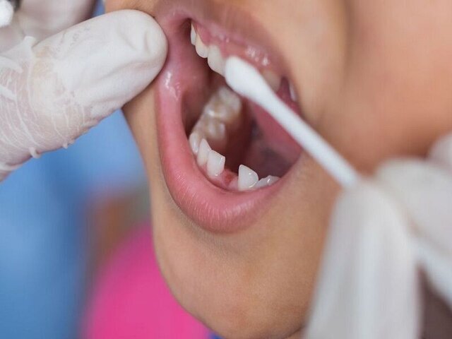ماده‌ای که ۴۰ درصد از پوسیدگی دندان پیشگیری می‌کند