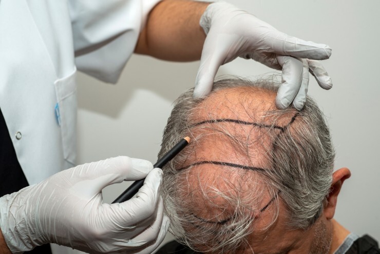 کاشت مو به روش FIT