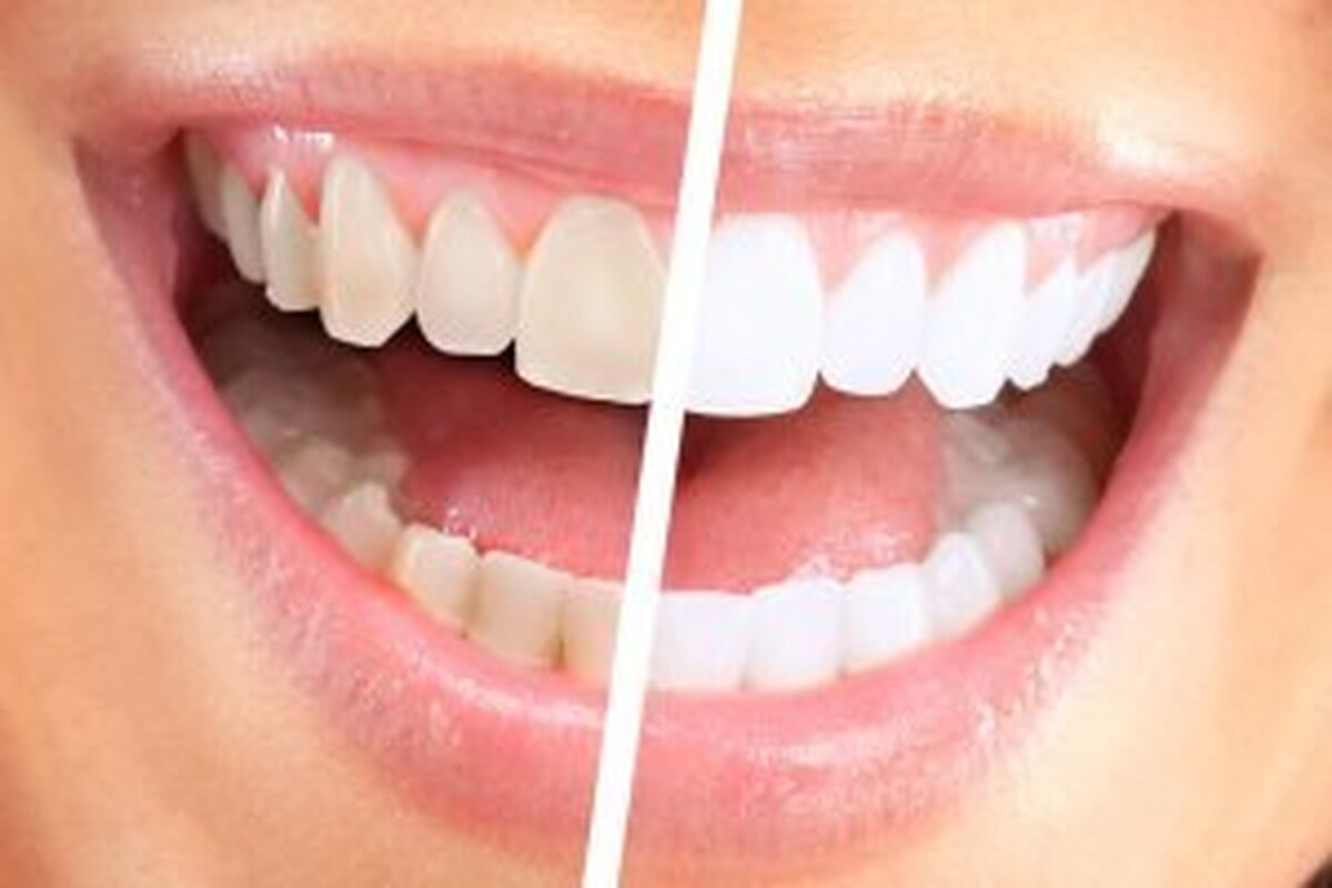 دلایل بدرنگی دندان‌ها چیست؟
