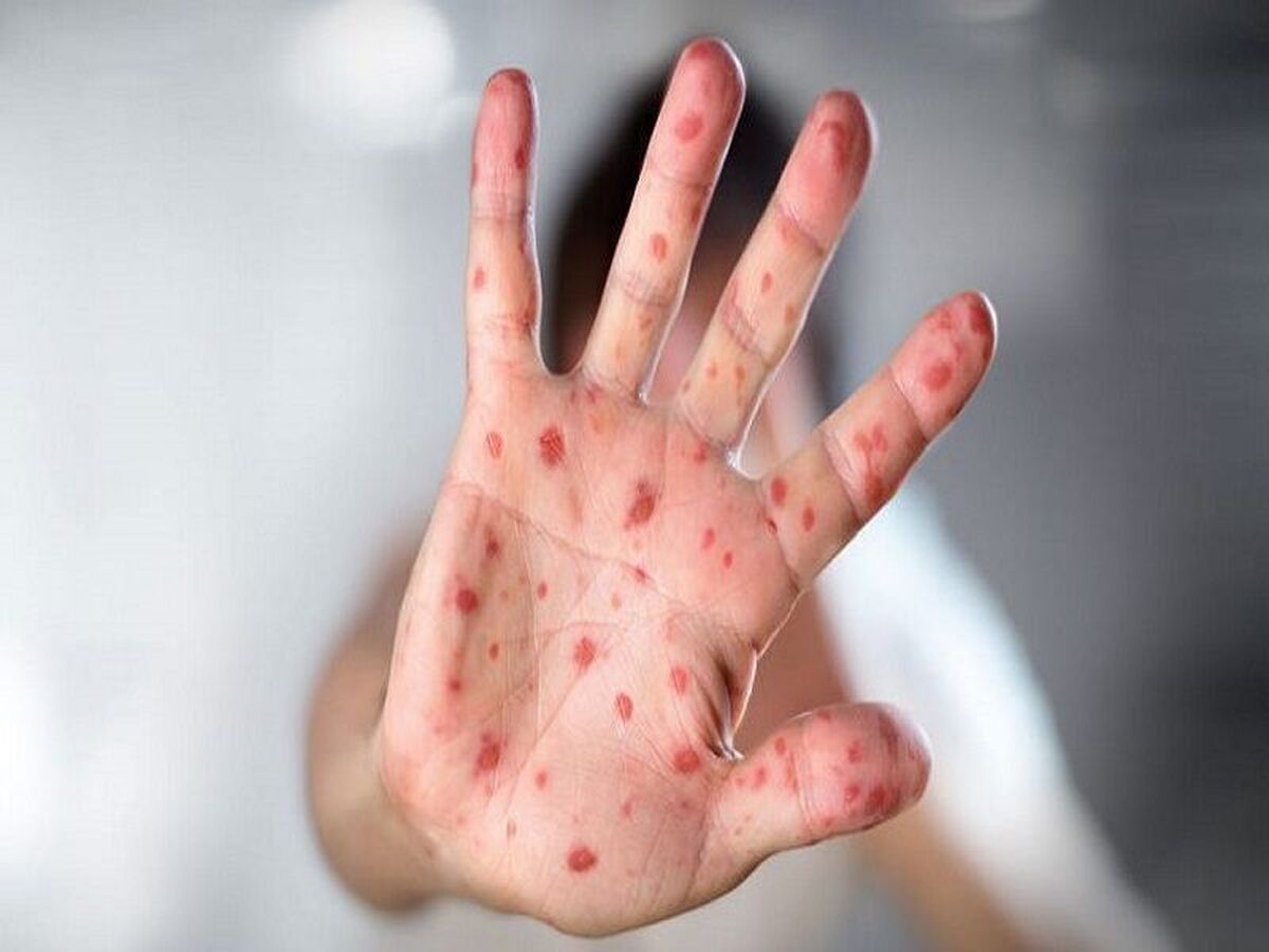 شیوع بیماری سرخک در عراق/واکسیناسیون قبل از شرکت در مراسم اربعین ضروری است